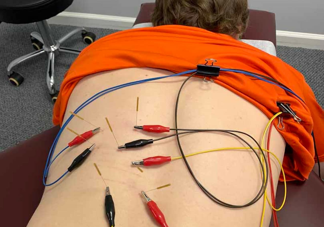 back-dry-needling
